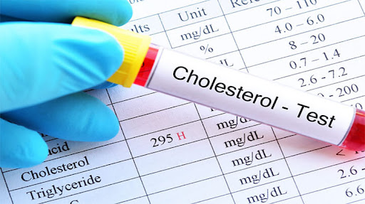 Kết quả xét nghiệm mỡ máu cao với chỉ số cholesterol và triglyceride vượt ngưỡng