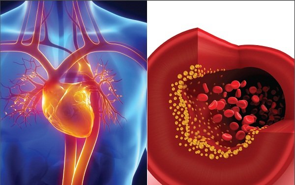 mỡ máu và cơ chế statin ức chế gan giảm sản xuất cholesterol