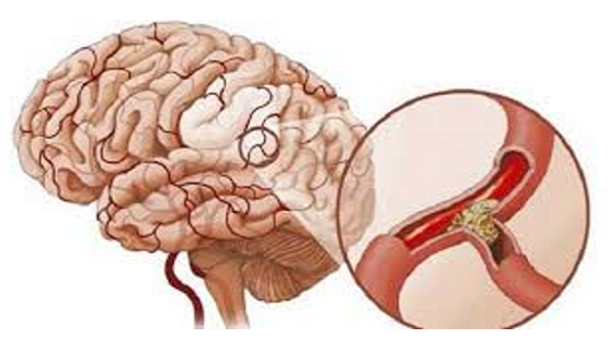 Đột quỵ do tắc mạch hình thành từ mảng xơ vữa tích tụ nhiều năm