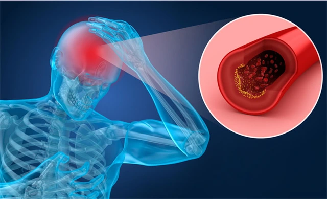 thiếu máu lên não gây choáng váng khi đứng lên